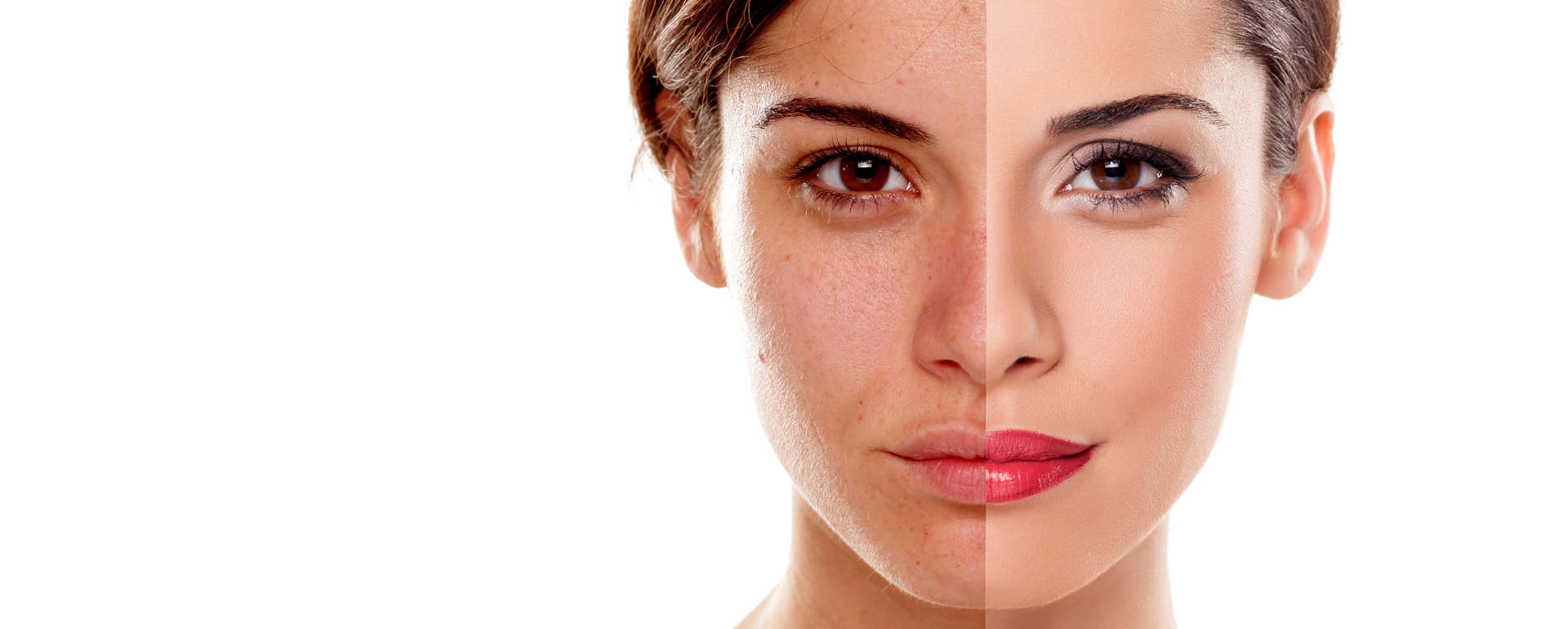 Peeling Treatment, Acne Treatment in Ahmedabad, Acne Treatment in Maninagar, Pimples Treatment in Ahmedabad, skin specialist in ahmedabad, best skin allergy specialist in ahmedabad, dermatologist in ahmedabad
